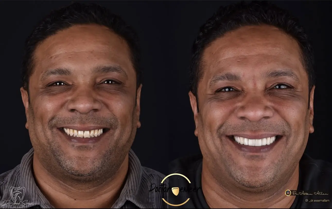 Case Before and After