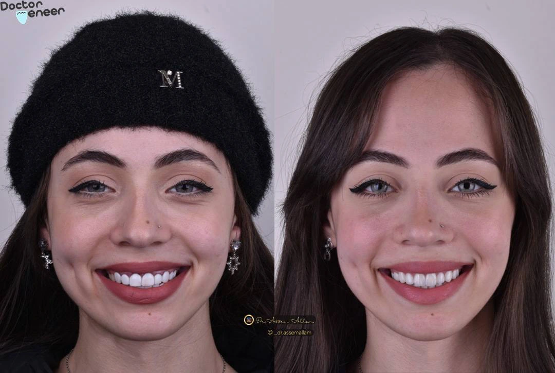 Smile transformation before and after: Shrouk's face